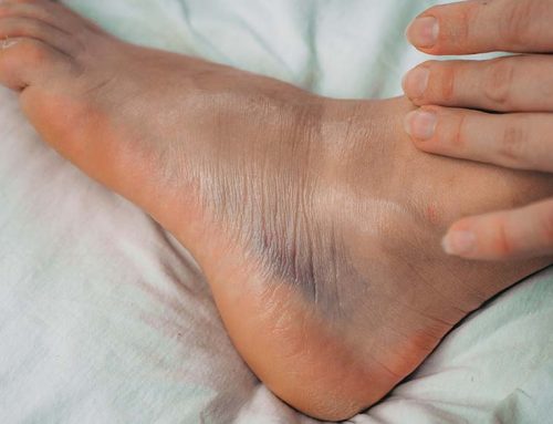 How Long Does A Sprained Ankle Take To Heal?
