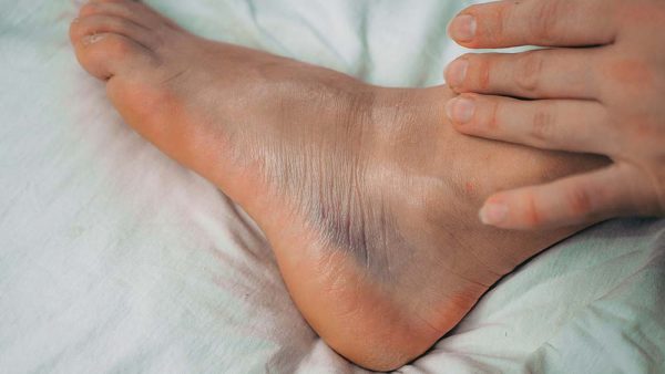 How Long Does A Sprained Ankle Take To Heal Elite Feet 