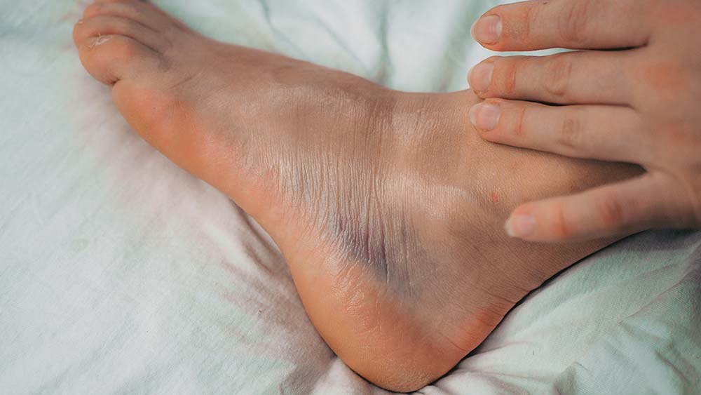  How Long Does A Sprained Ankle Take To Heal Elite Feet