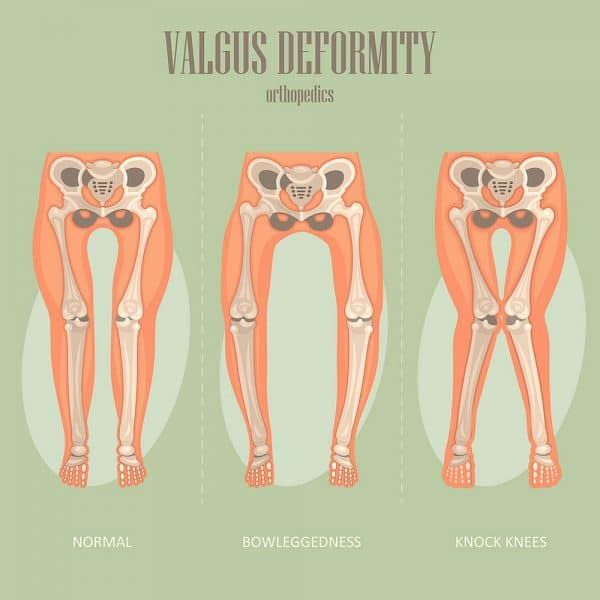 knee-valgus-how-to-fix-knock-knees-elite-feet